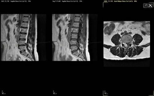 Se puede comer antes de una resonancia magnética lumbar